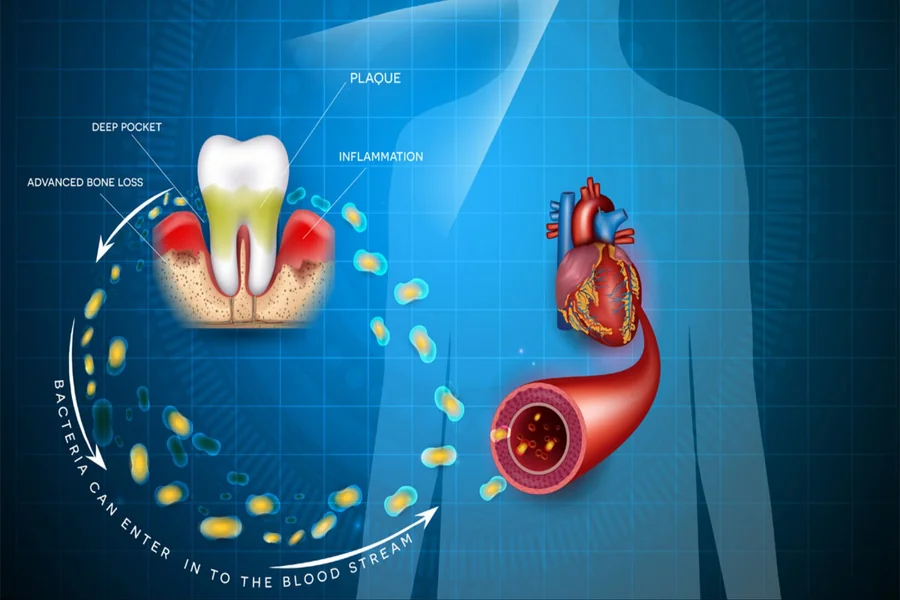 The Connection Between Periodontal Disease And Heart Health